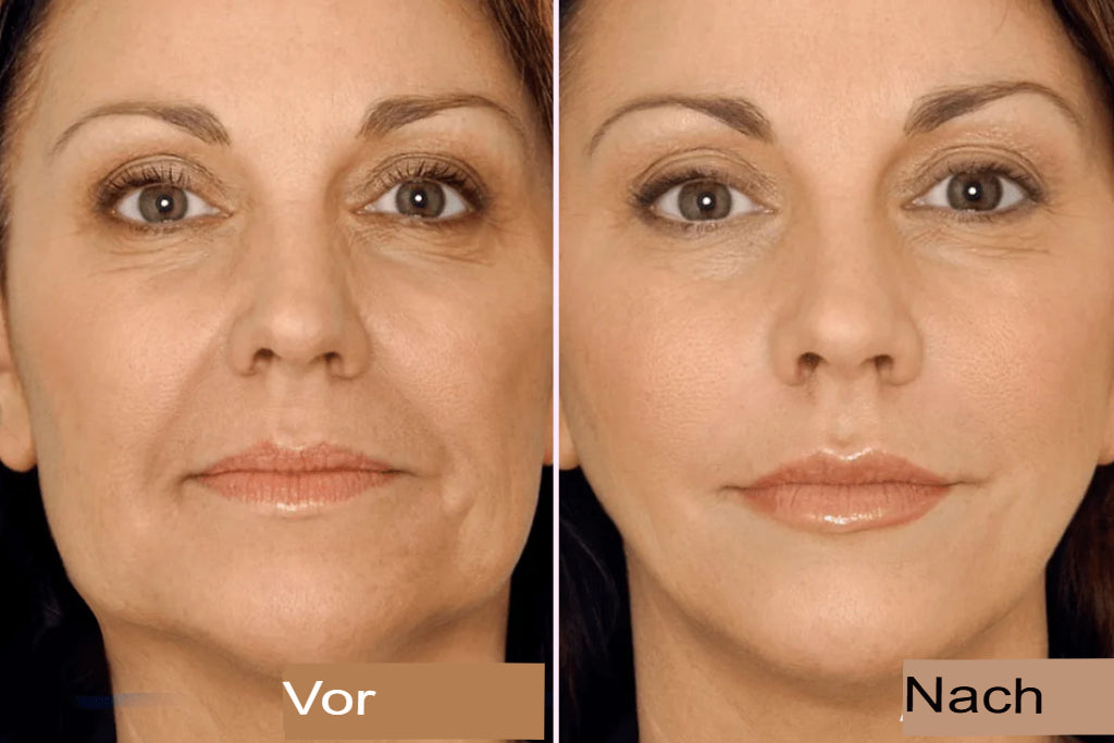 Unsichtbares Lifting-Tape für das Gesicht – V-Form Anti-Falten