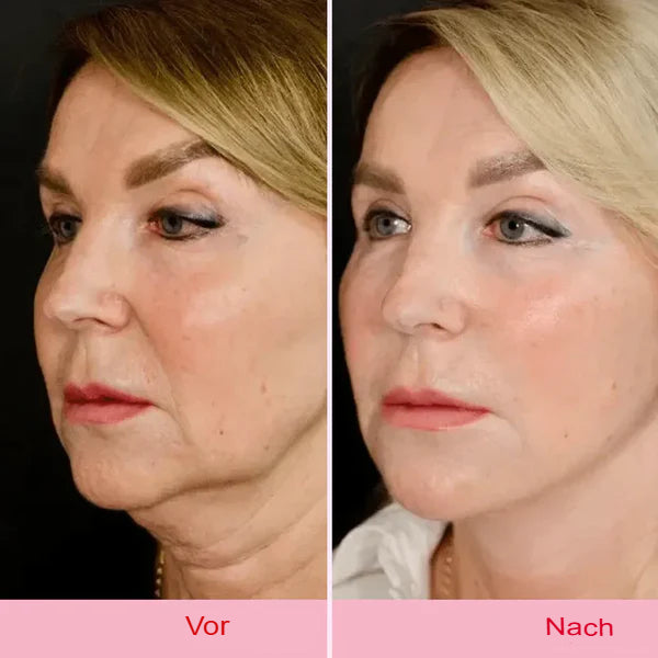 Unsichtbares Lifting-Tape für das Gesicht – V-Form Anti-Falten
